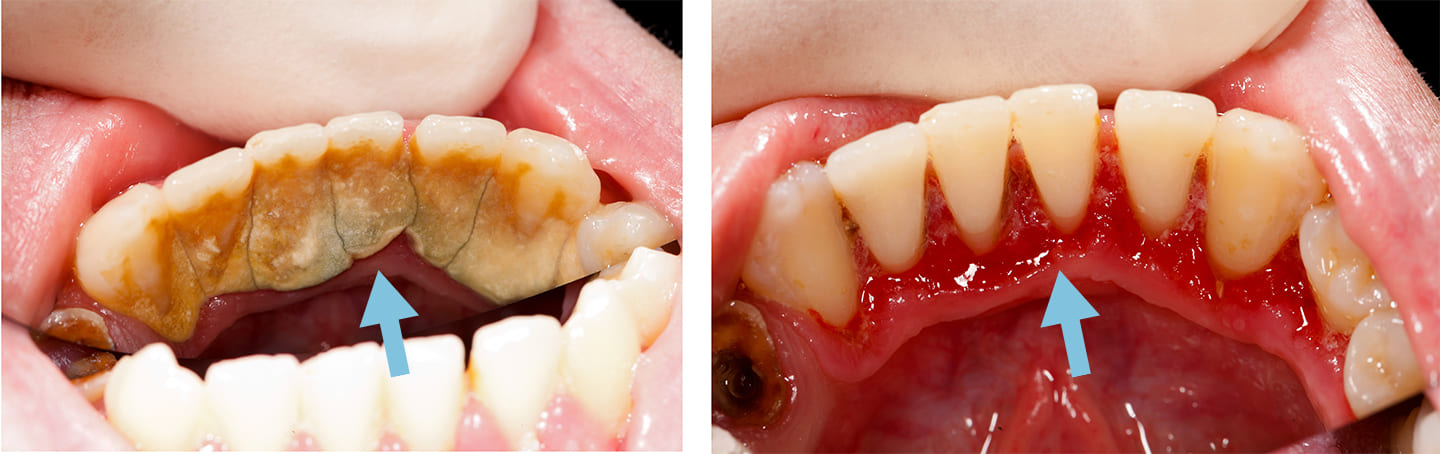 歯石を除去すると、その下の歯茎は「炎症」を起こし、赤く腫れている。
