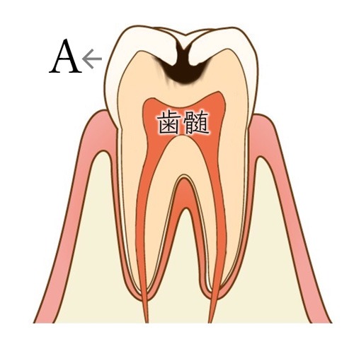 歯の硬い部分が虫歯になってしまった状態