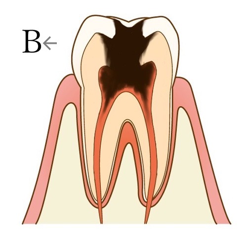 細菌が「歯髄」まで到達してしまった状態